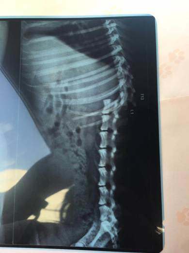 Spine Broken After Accident