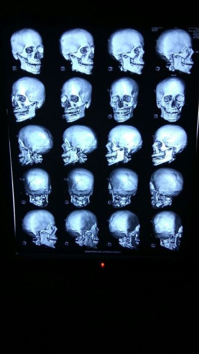X-ray 2