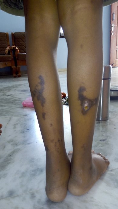 During liver and kidney treatment his bilateral leg pain treatment