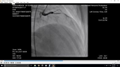 Angiogram showing the Type III vessel blockage