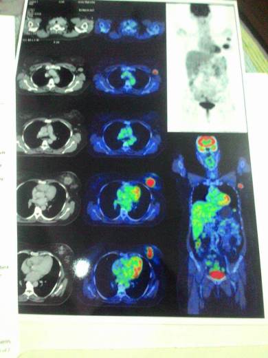 CT scan