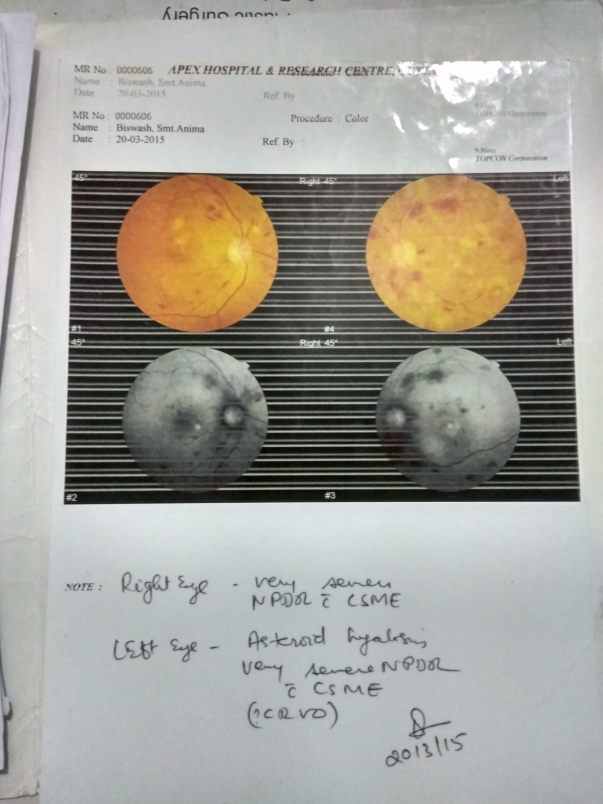Retina scan report came very bad