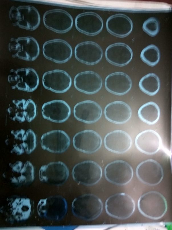 CT scan of brain after brain strok