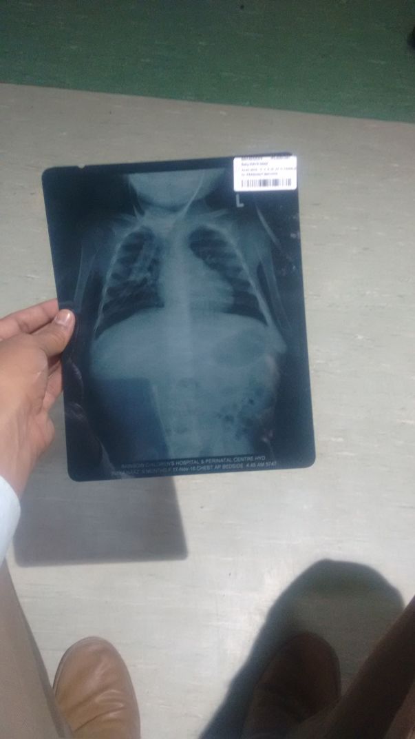 Lung Xray