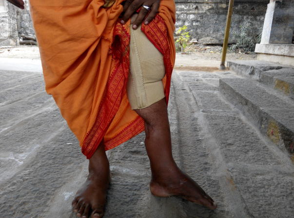 fractured leg