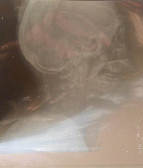 X ray1- uploaded by Himachali Blood Donors'