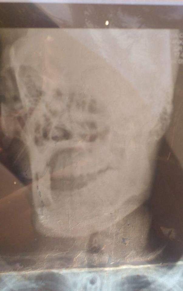 X ray2- uploaded by Himachali Blood Donors'