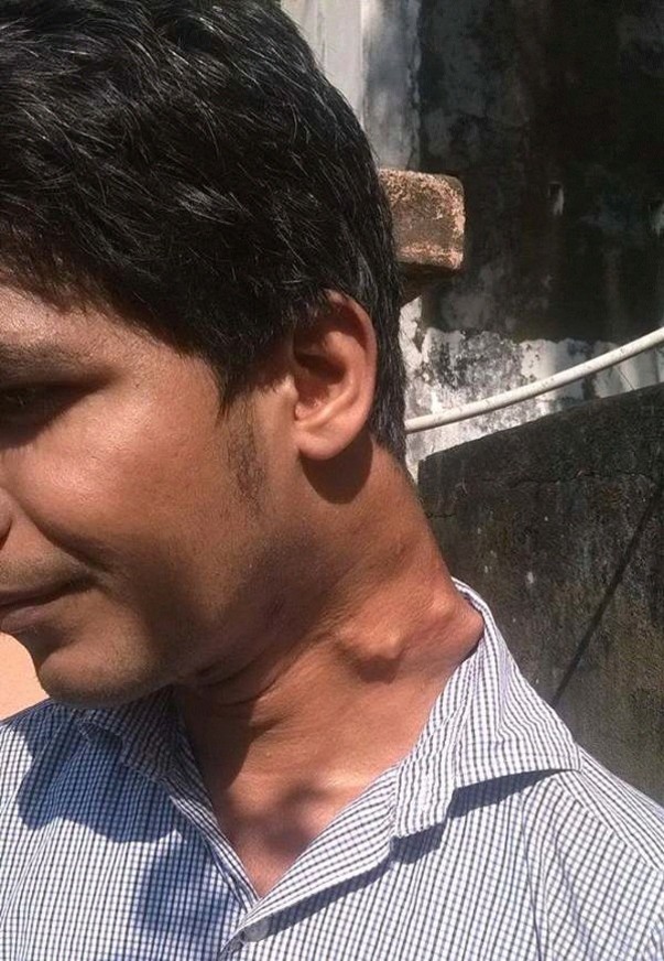 Rameez with his current growths in left neck