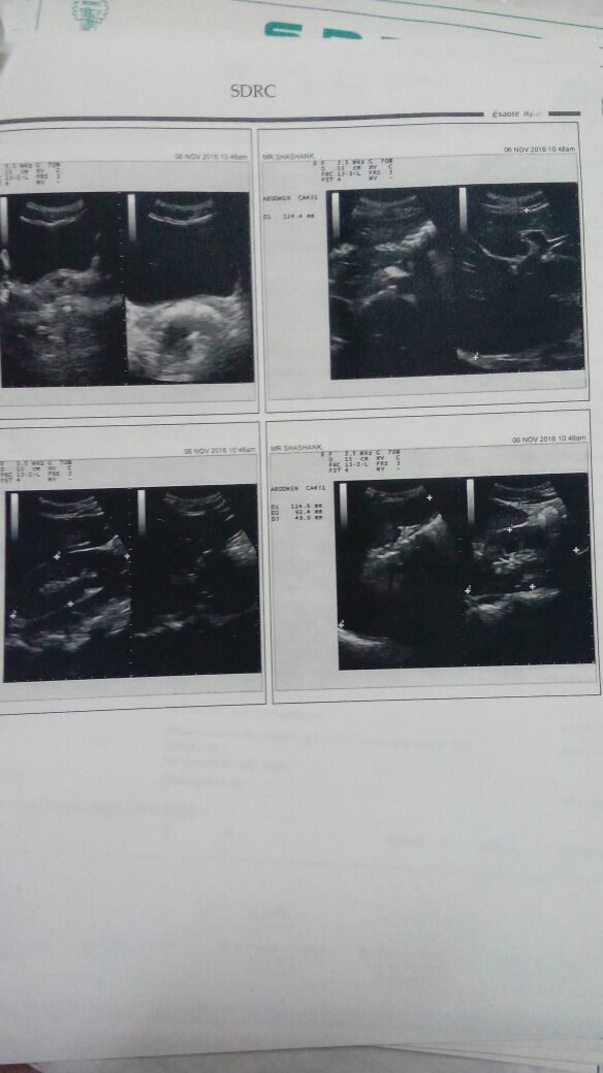 2 MRI Scan Of Spinal chord