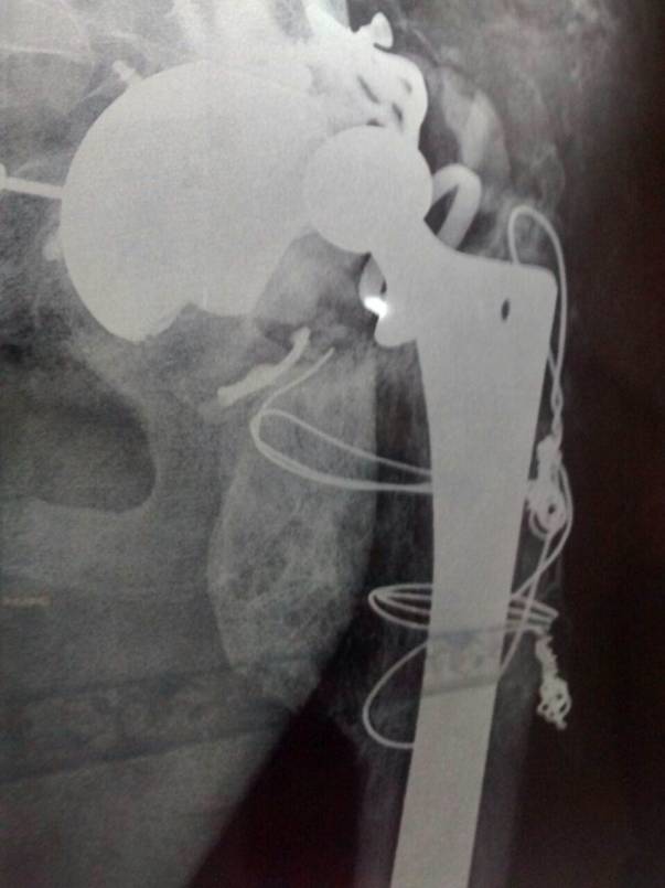 reconstructed acetabulum ( hip joint)