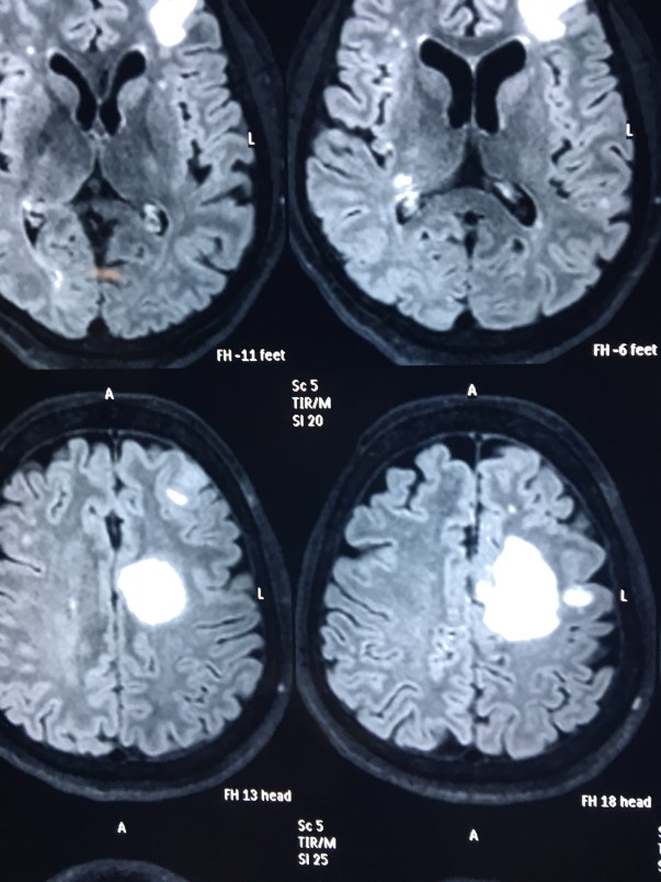 MRI REPORT 1