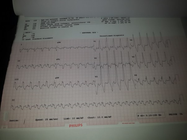 ECG