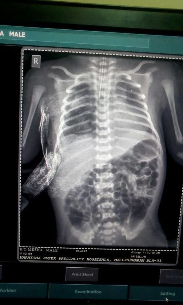 Xray Of B/O Priti showing perforation