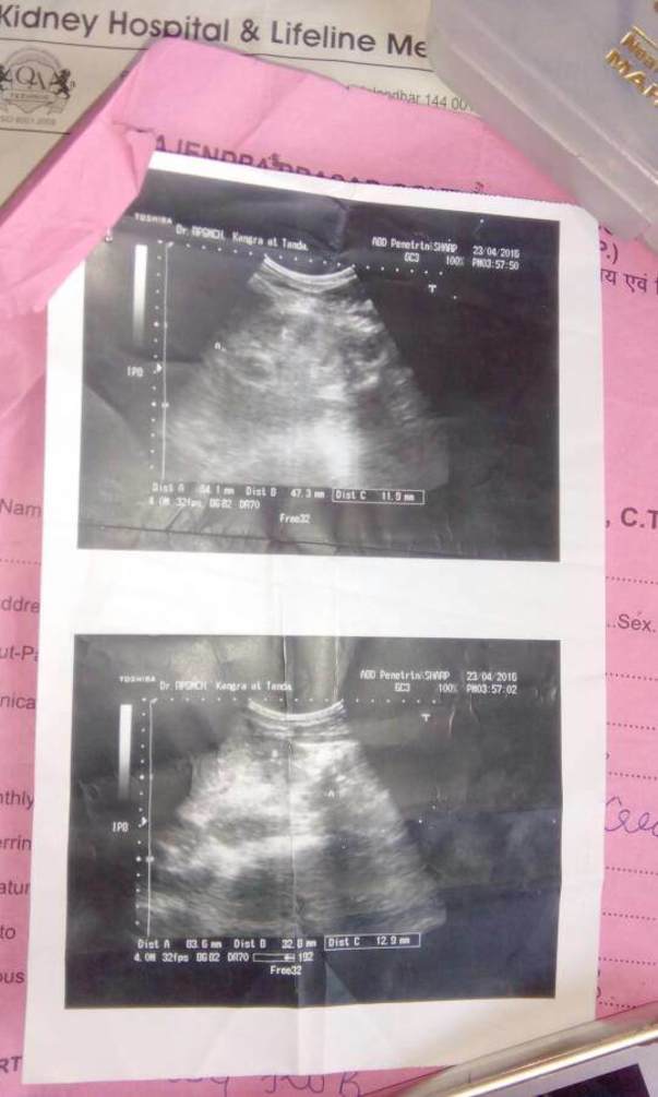 X-ray Of kidney