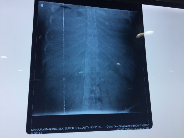 Chest X-Ray
