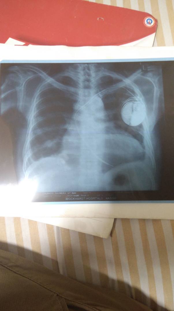 X ray of ICD implantation