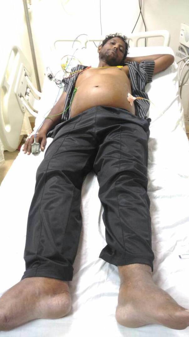 My brother admitted in icu in care hospitals