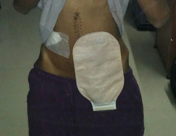 My stoma pouch