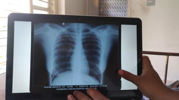 Chest XRay
