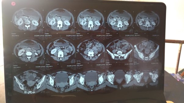 CT Scan