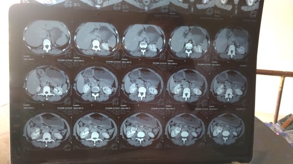 CT Scan