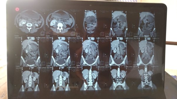 CT Scan