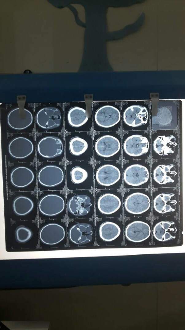 CT scan film