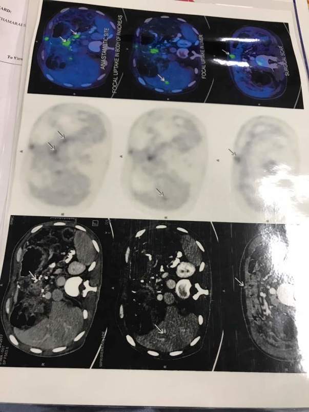 Cancer Report - Full body scan Report - 1