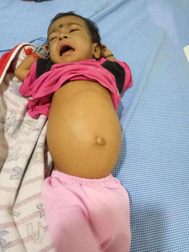 Before Liver Transplant