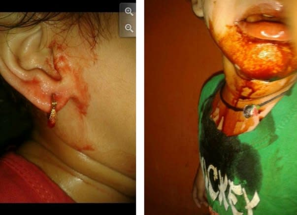 Uncontrolled bleeding