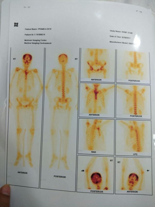 Bone Scan