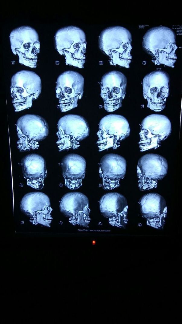 X-ray 2