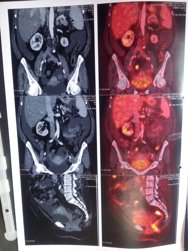 Pet scan Image 1