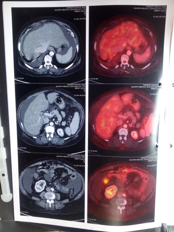 Pet scan Image2