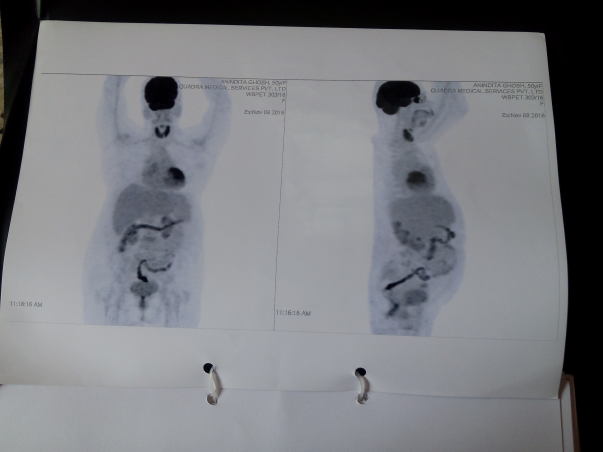Pet scan 3