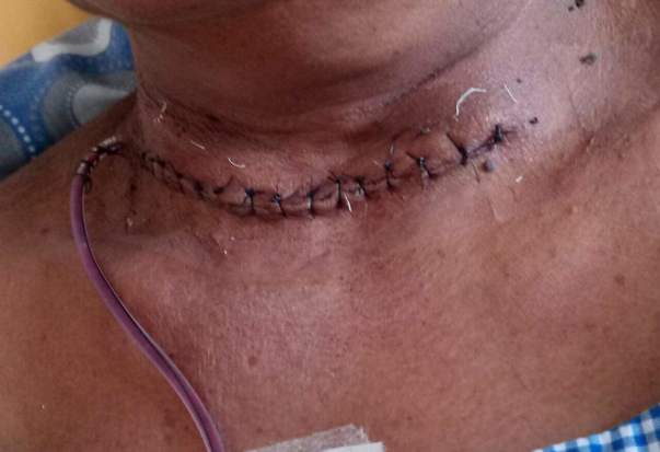 after surgery photo