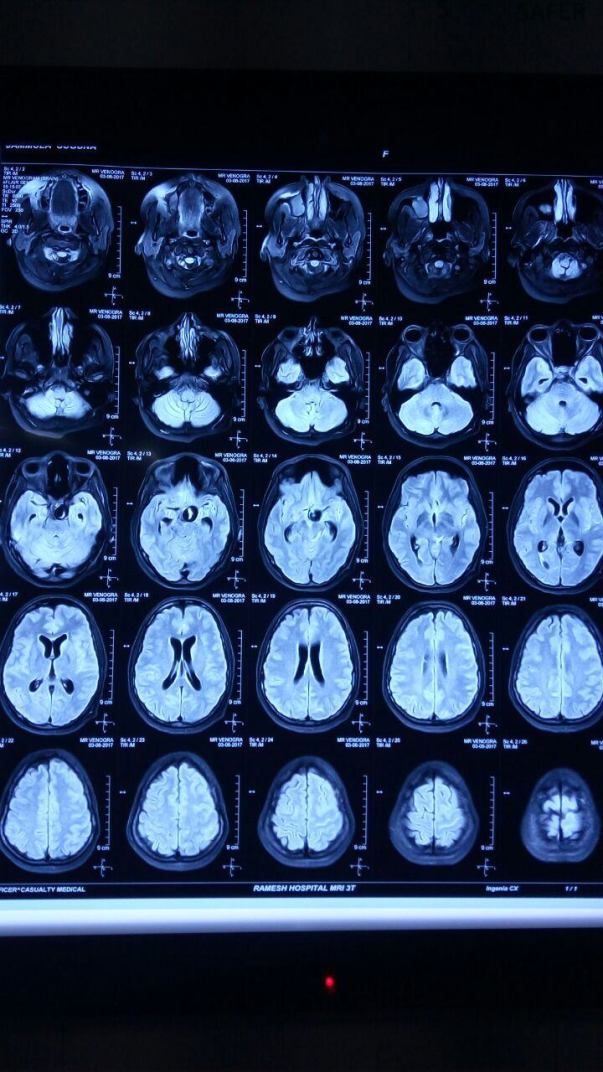 MRI Brain -2