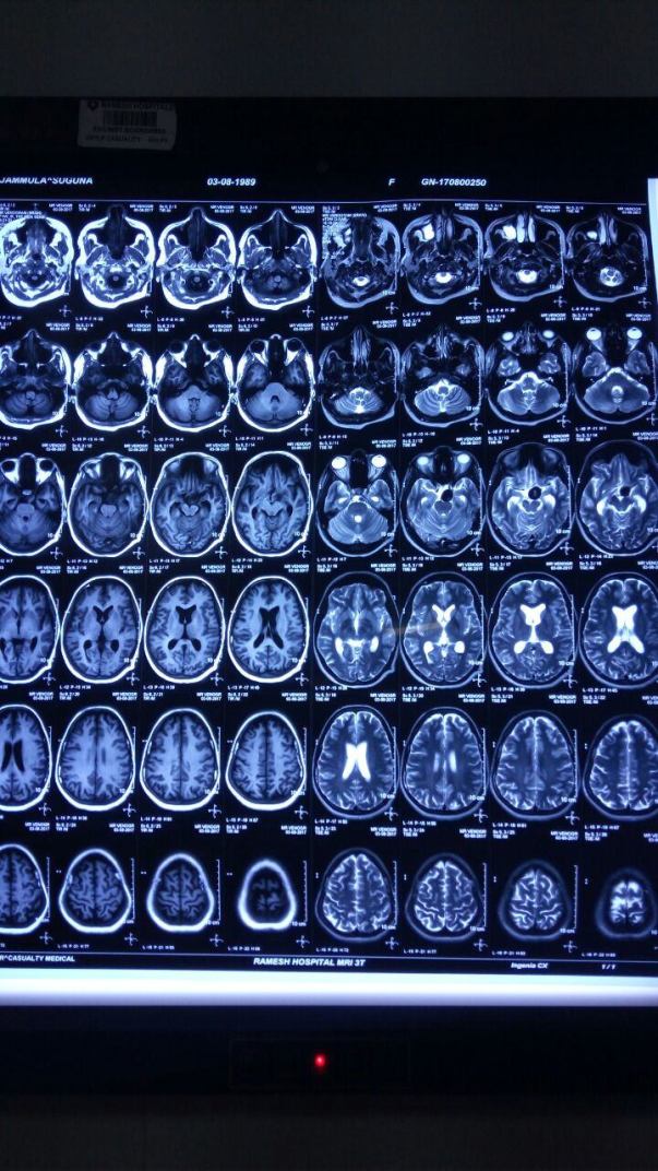 MRI Brain -3