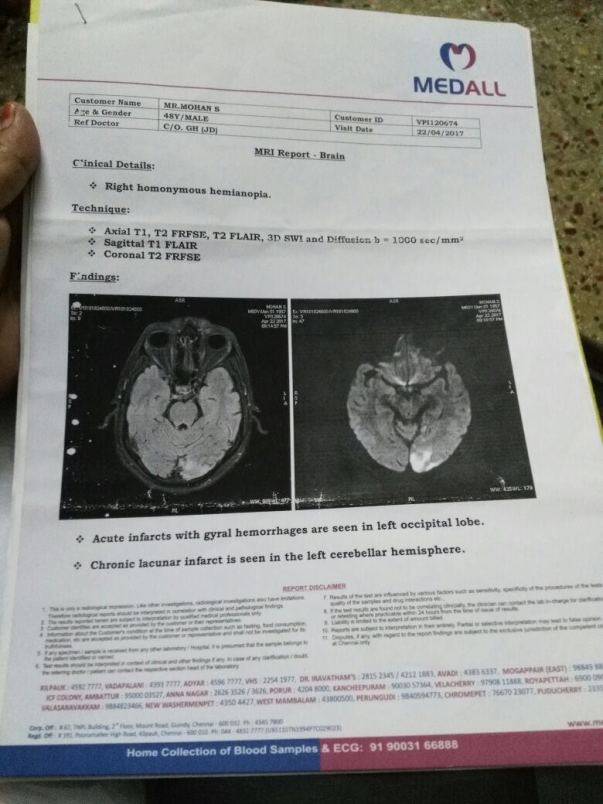 Hemianopia in brain