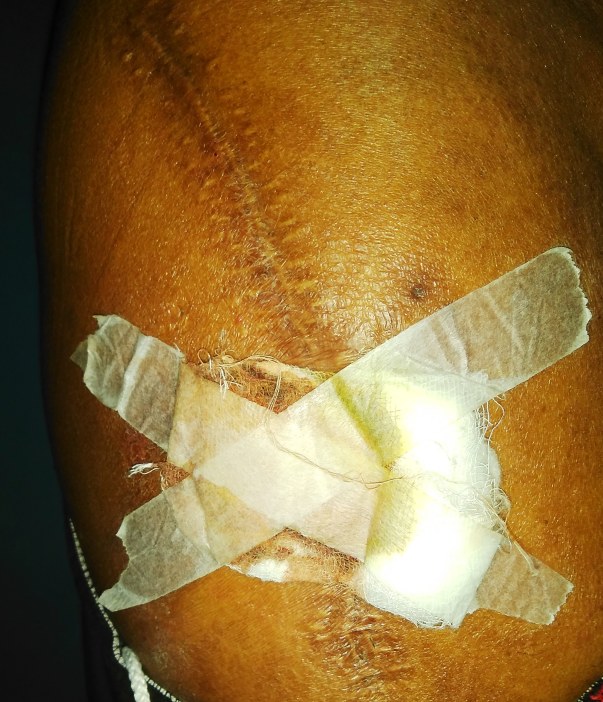 Puss Formation in my operated right leg due to implants and screws problems