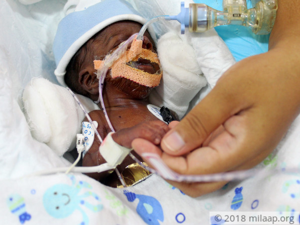 Nurse's 20-day-old Baby Is Now Bleeding Into His Lungs And Needs Help