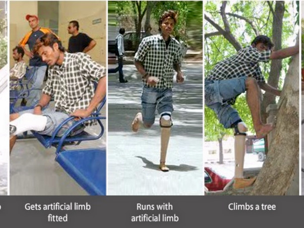 Fundraising to help Jaipur foot provide artificial limbs to 200 amputees. Support my project!