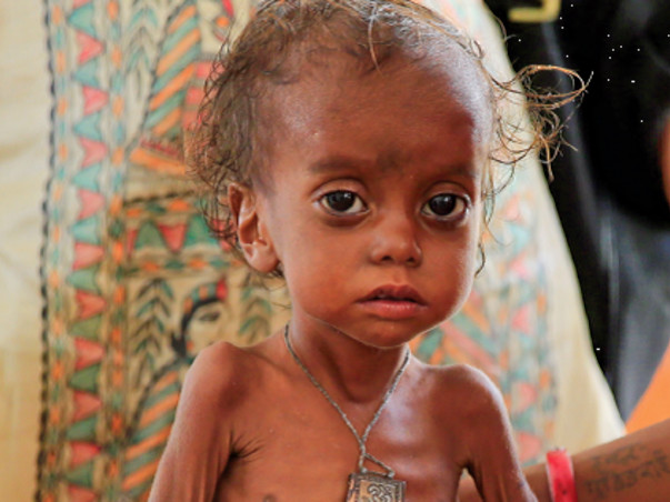You can save the lives of 40 malnourished children