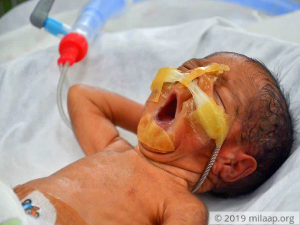 Twins Born After 26 Years Of Marriage Are Now Fighting To Survive