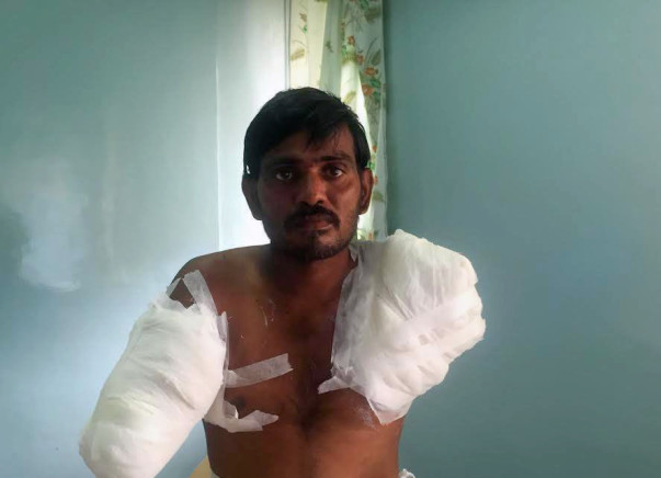 Help Rama Subahiah to undergo treatment for his burnt hands.