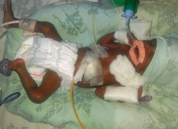 SAVE THIS PREMATURE BABY