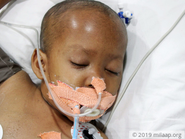 Partially Blind 5-Year-Old Needs ICU Stay To Recover From Infections