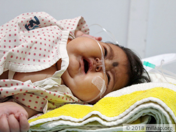 Help 5 months old Sanjana to get a Bone Marrow Transplant