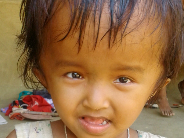 Help 4 Year Old Reshmi Fight Hydrocephalus