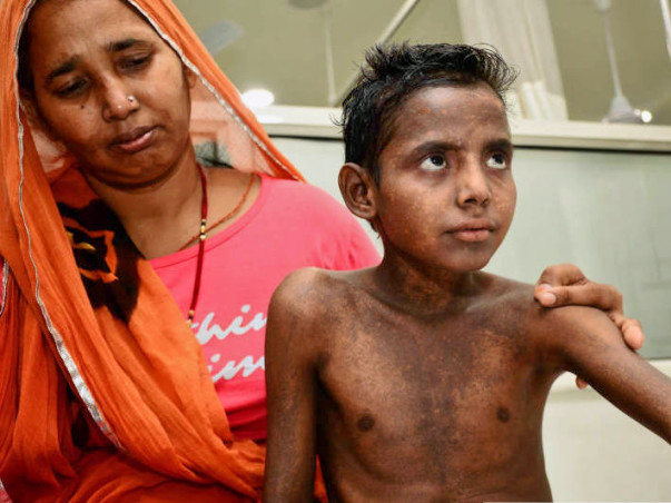 14-year-old with painful boils all over body needs urgent transplant
